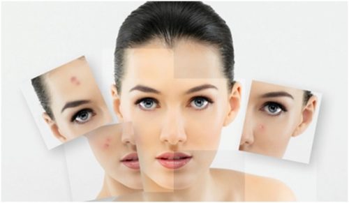 facial acne-aha-101