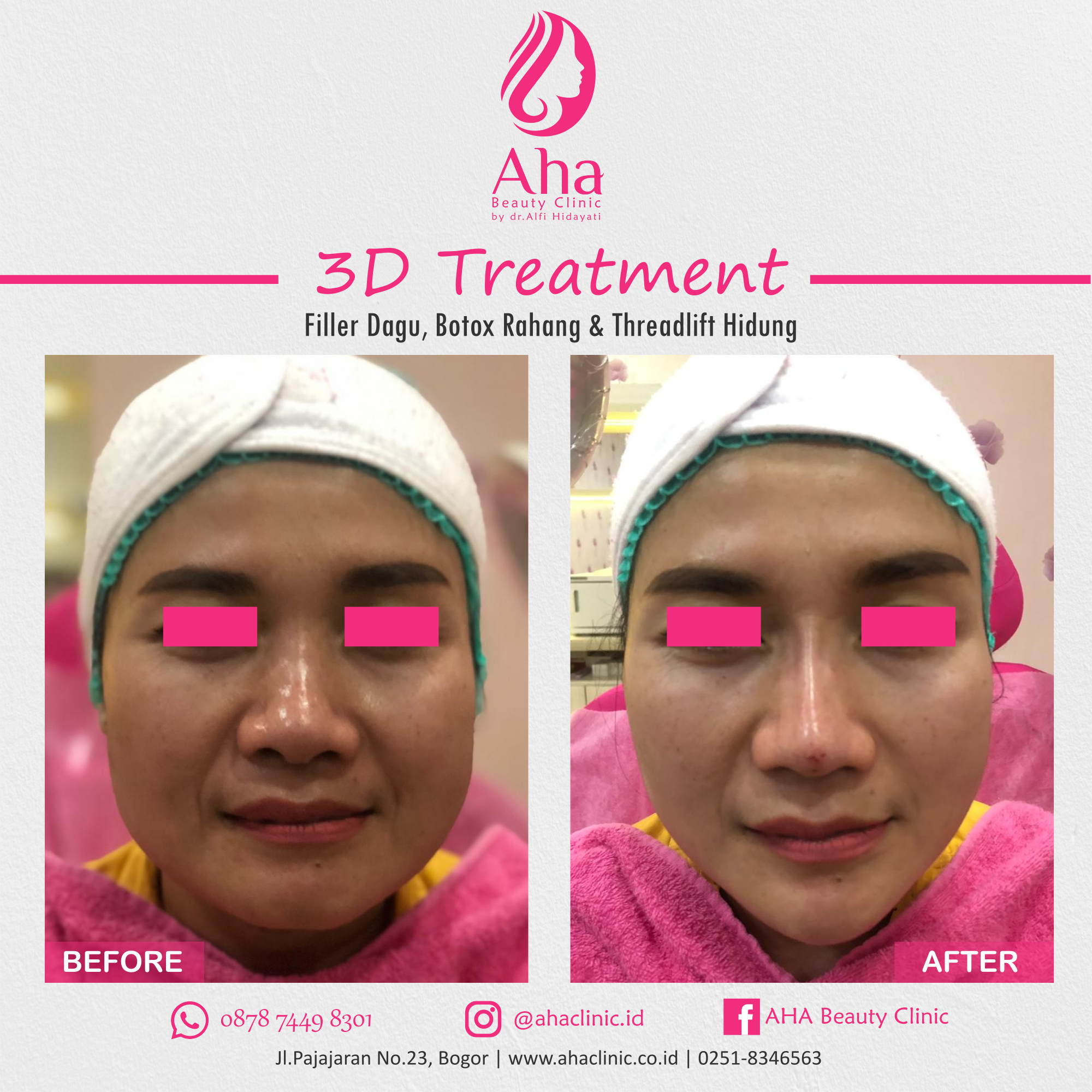 BEFORE AFTER 3D TREATMENT