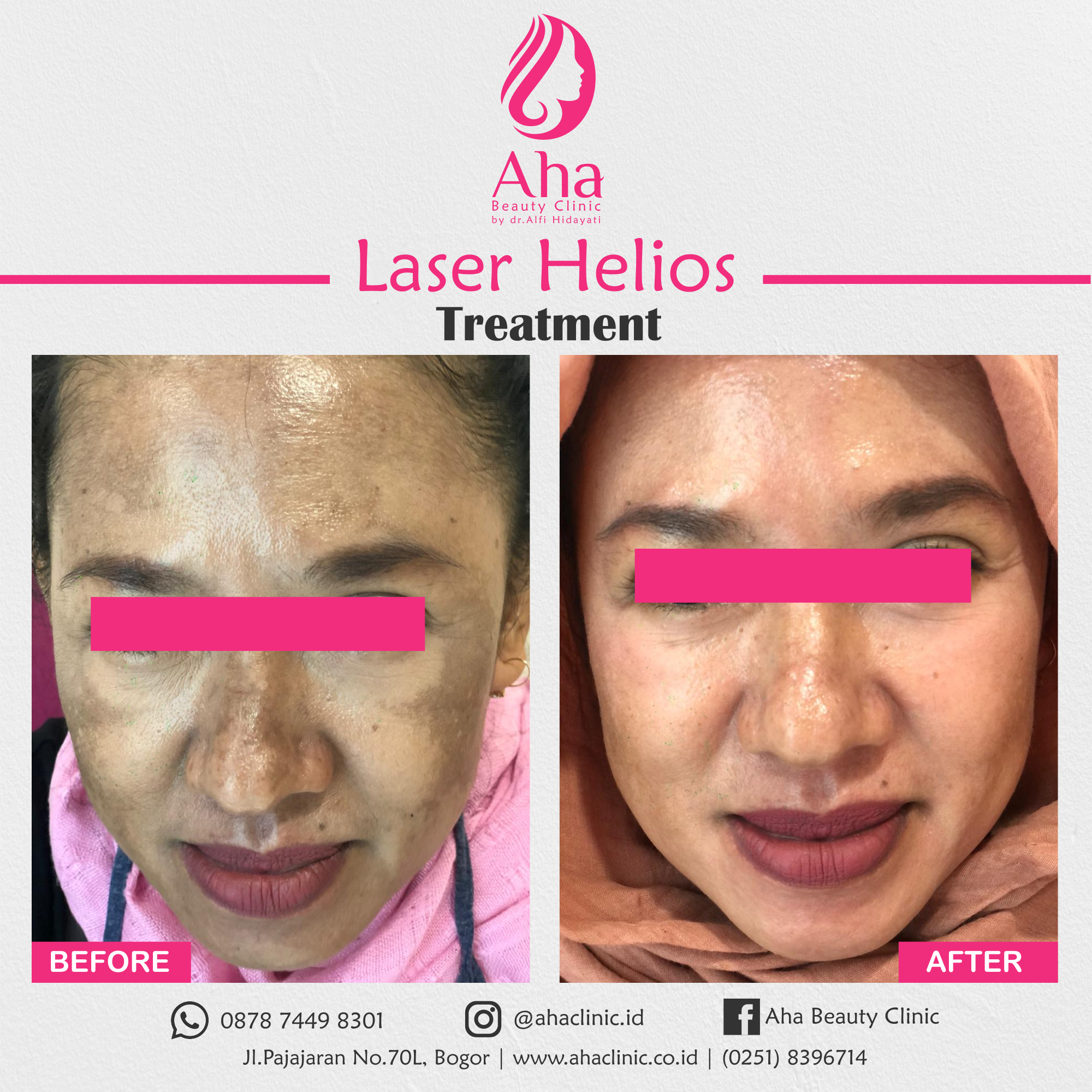 BEFORE-AFTER LASER-7a